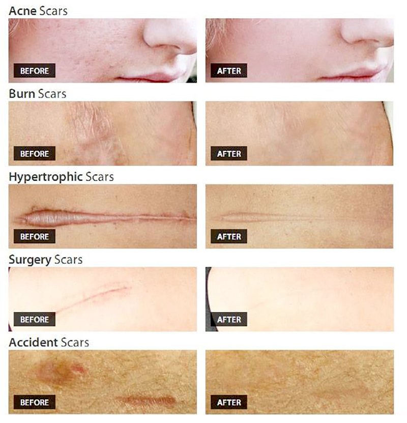 ดูแลแผลเป็นนูน คีลอยด์ ด้วยเทคนิค Triple Laser Therapy: Picosecond Laser + Gold Toning + Fractional Laser + ฉีดยา Intralesional Injection ดูแลแผลเป็นนูน คีลอยด์ ด้วยเทคนิค Triple Laser Therapy: Picosecond Laser + Gold Toning + Fractional Laser + ฉีดยา Intralesional Injection