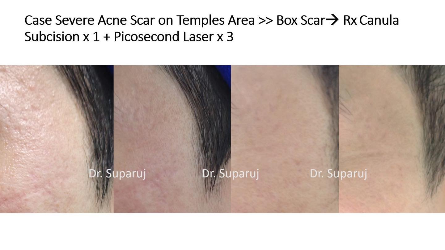 หลุมสิวบริเวณขมับดูแลรักษาได้อย่างไรบ้าง? หลุมสิวบริเวณขมับดูแลรักษาได้อย่างไรบ้าง?