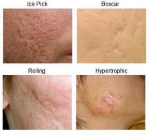 หลุมสิวบริเวณขมับดูแลรักษาได้อย่างไรบ้าง? หลุมสิวบริเวณขมับดูแลรักษาได้อย่างไรบ้าง?