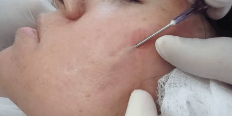 ดูแลรักษาหลุมสิวเทคนิคตัดพังผืดหลุมสิว  Special Subcision Technique  ดูแลรักษาหลุมสิวเทคนิคตัดพังผืดหลุมสิว  Special Subcision Technique