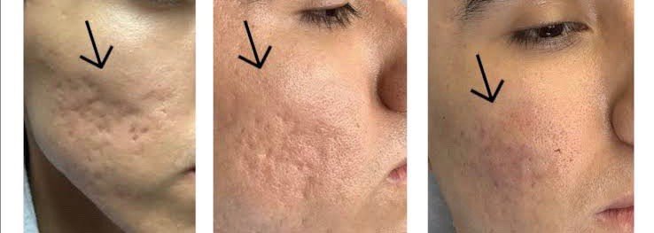 หลุมสิวบริเวณขมับดูแลรักษาได้อย่างไรบ้าง? หลุมสิวบริเวณขมับดูแลรักษาได้อย่างไรบ้าง?