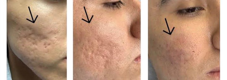 ดูแลรักษาหลุมสิวเทคนิคตัดพังผืดหลุมสิว  Special Subcision Technique  ดูแลรักษาหลุมสิวเทคนิคตัดพังผืดหลุมสิว  Special Subcision Technique