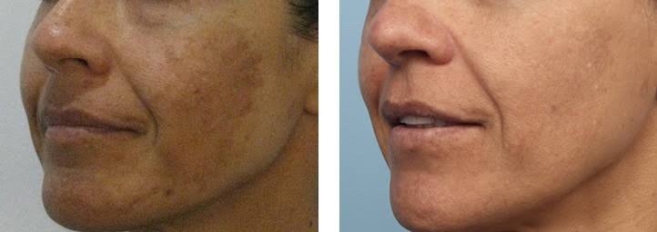 โปรแกรมฉีดรักษาฝ้า Channel Melasma Clear Program ที่ DeMed Clinic