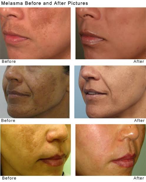 PicoLaser Melasma Treatment Program โปรแกรมดูแลฝ้าครบวงจร 