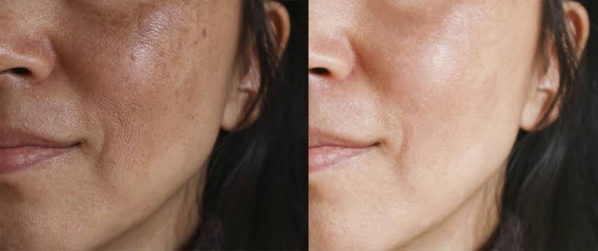 โปรแกรมฉีดรักษาฝ้า Channel Melasma Clear Program ที่ DeMed Clinic