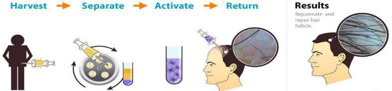 ปลูกผมด้วยเทคนิคพิเศษล่าสุด Regenera Hair Stem MicroTransplantation Plus (HSMT+) ปลูกผมด้วยเทคนิคพิเศษล่าสุด Regenera Hair Stem MicroTransplantation Plus (HSMT+)