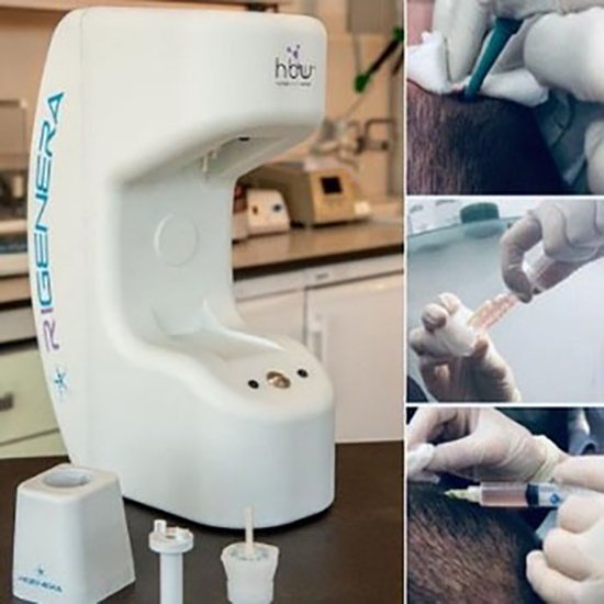 ปลูกผมด้วยเทคนิคพิเศษล่าสุด Regenera Hair Stem MicroTransplantation Plus (HSMT+) ปลูกผมด้วยเทคนิคพิเศษล่าสุด Regenera Hair Stem MicroTransplantation Plus (HSMT+)