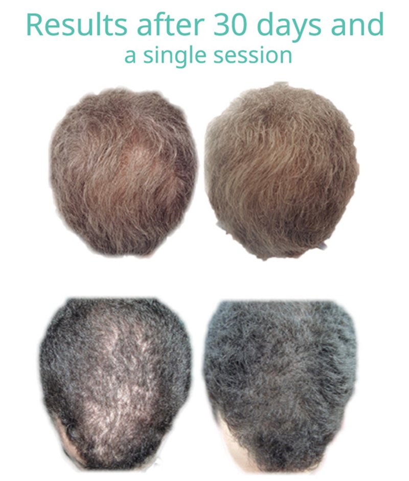 ปลูกผมด้วยเทคนิคพิเศษล่าสุด Regenera Hair Stem MicroTransplantation Plus (HSMT+)