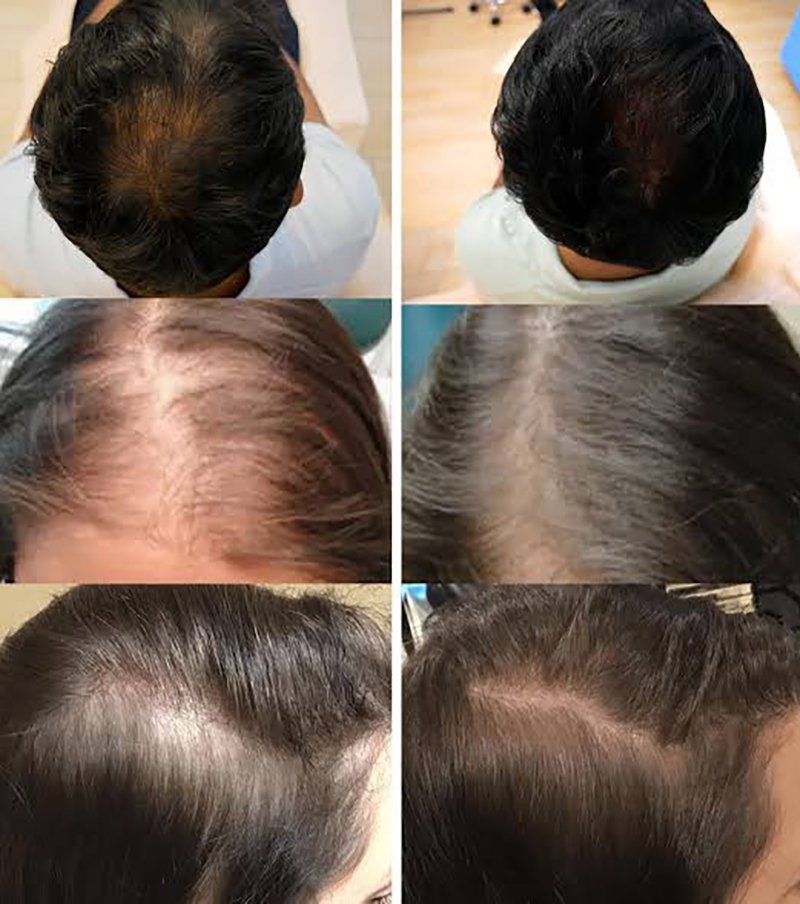 ดูแลผมร่วง ผมบางด้วย Regenera Hair Stem Cell Therapy !!