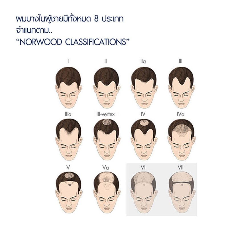 การปลูกผม (Hair Transplantation) คืออะไร การปลูกผม (Hair Transplantation) คืออะไร