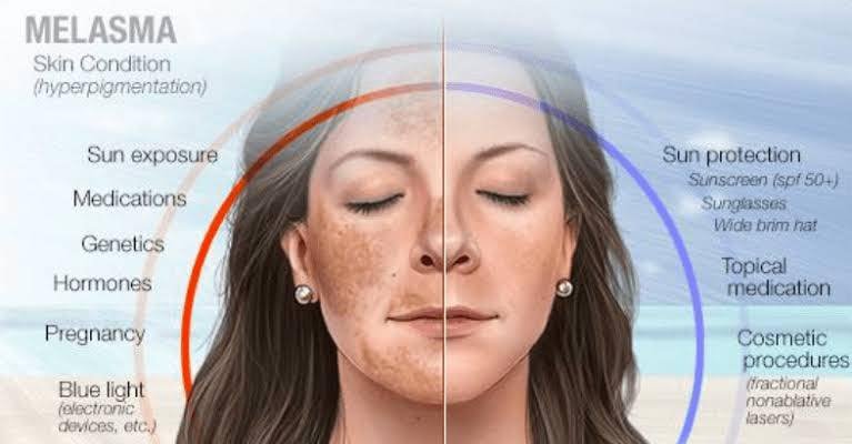 เป็นฝ้าแล้วต้องรีบเลเซอร์ไหม? เป็นฝ้าแล้วต้องรีบเลเซอร์ไหม?