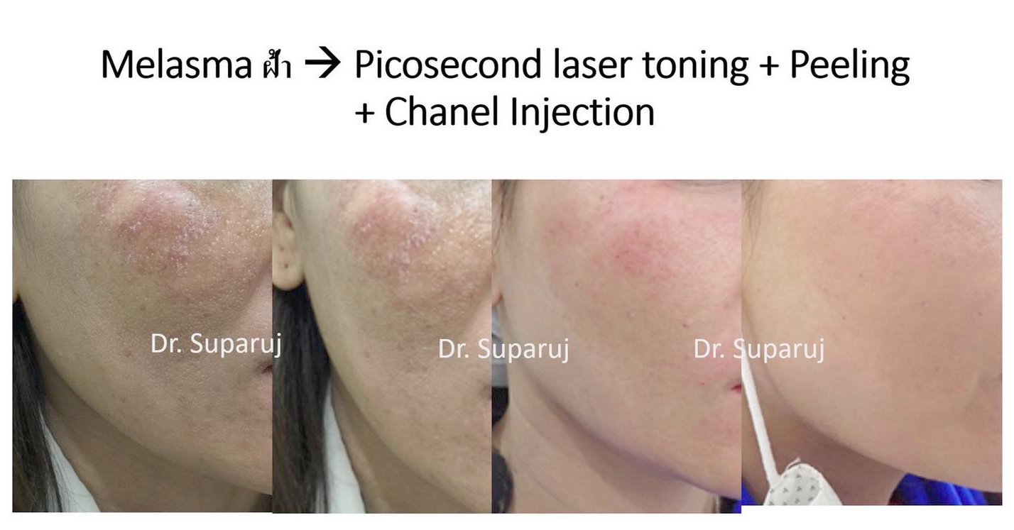 เป็นฝ้าแล้วต้องรีบเลเซอร์ไหม? เป็นฝ้าแล้วต้องรีบเลเซอร์ไหม?