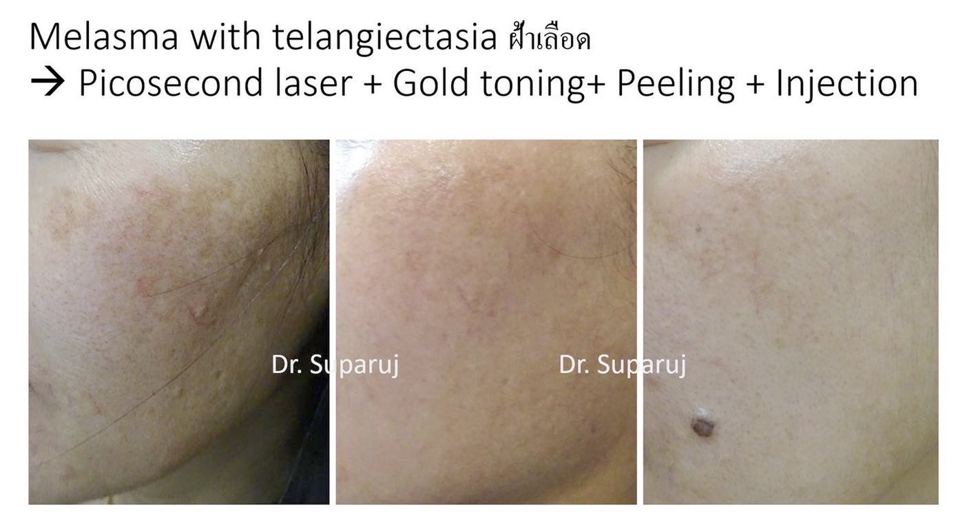 เป็นฝ้าแล้วต้องรีบเลเซอร์ไหม? เป็นฝ้าแล้วต้องรีบเลเซอร์ไหม?