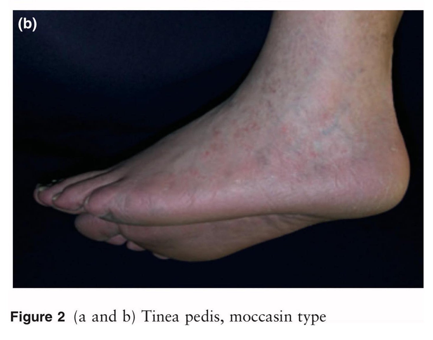 ระวังโรคผิวหนังที่มากับหน้าฝน!!! ระวังโรคผิวหนังที่มากับหน้าฝน!!!