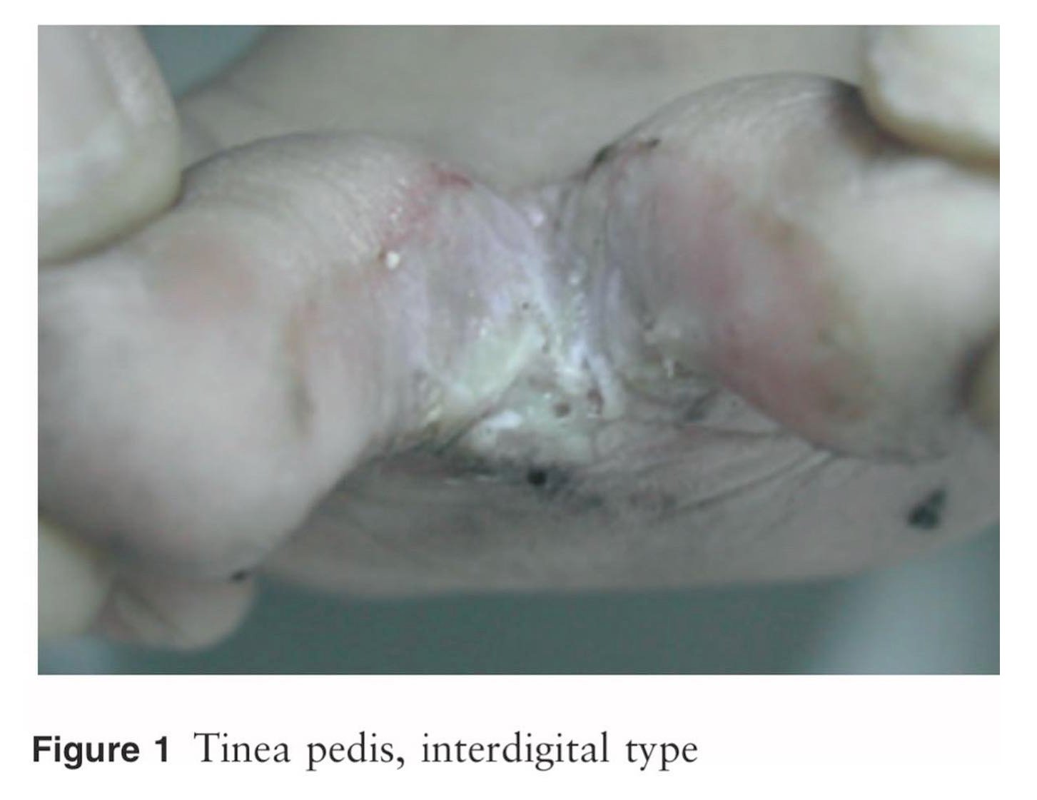 ระวังโรคผิวหนังที่มากับหน้าฝน!!! ระวังโรคผิวหนังที่มากับหน้าฝน!!!