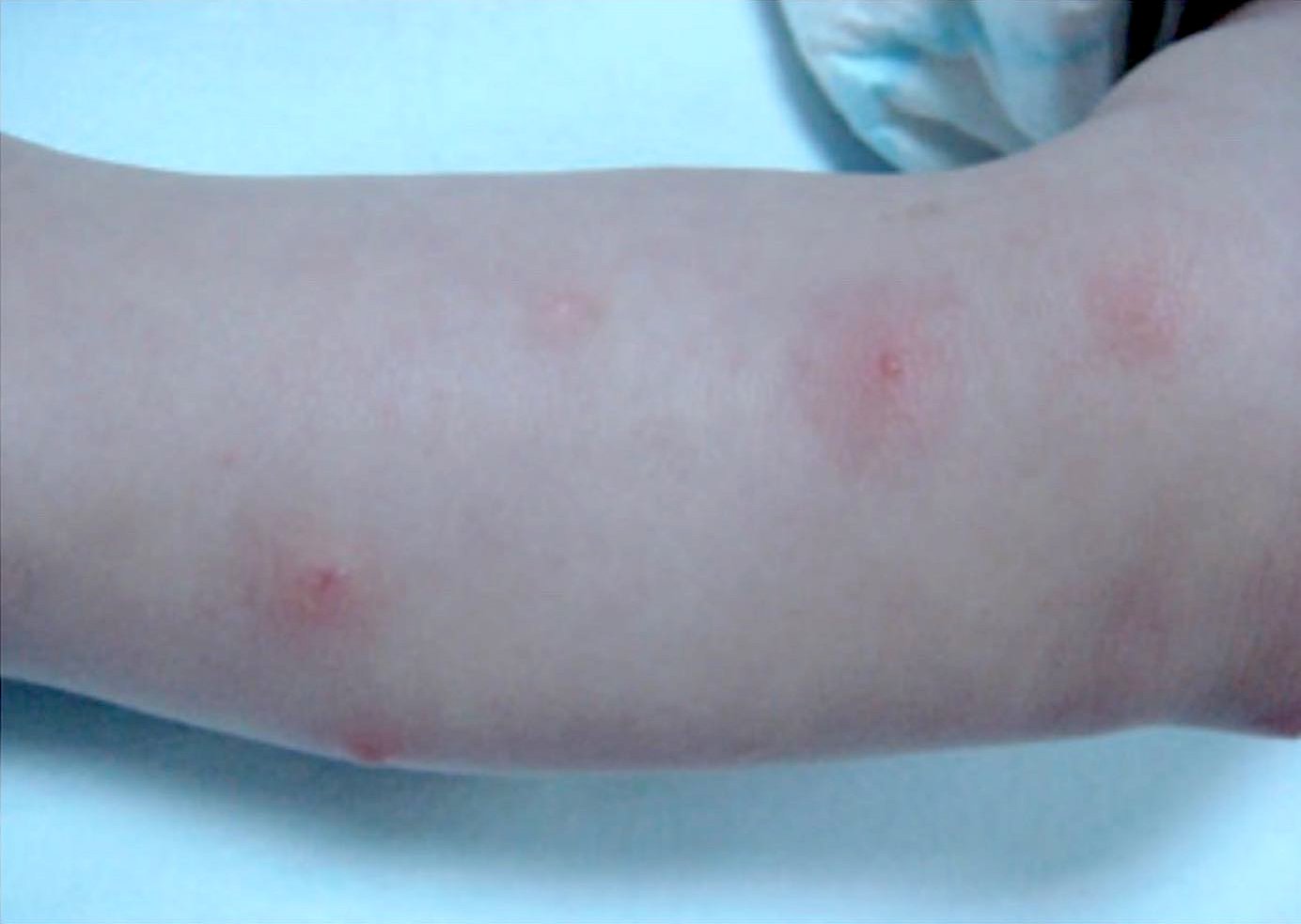 ระวังโรคผิวหนังที่มากับหน้าฝน!!! ระวังโรคผิวหนังที่มากับหน้าฝน!!!