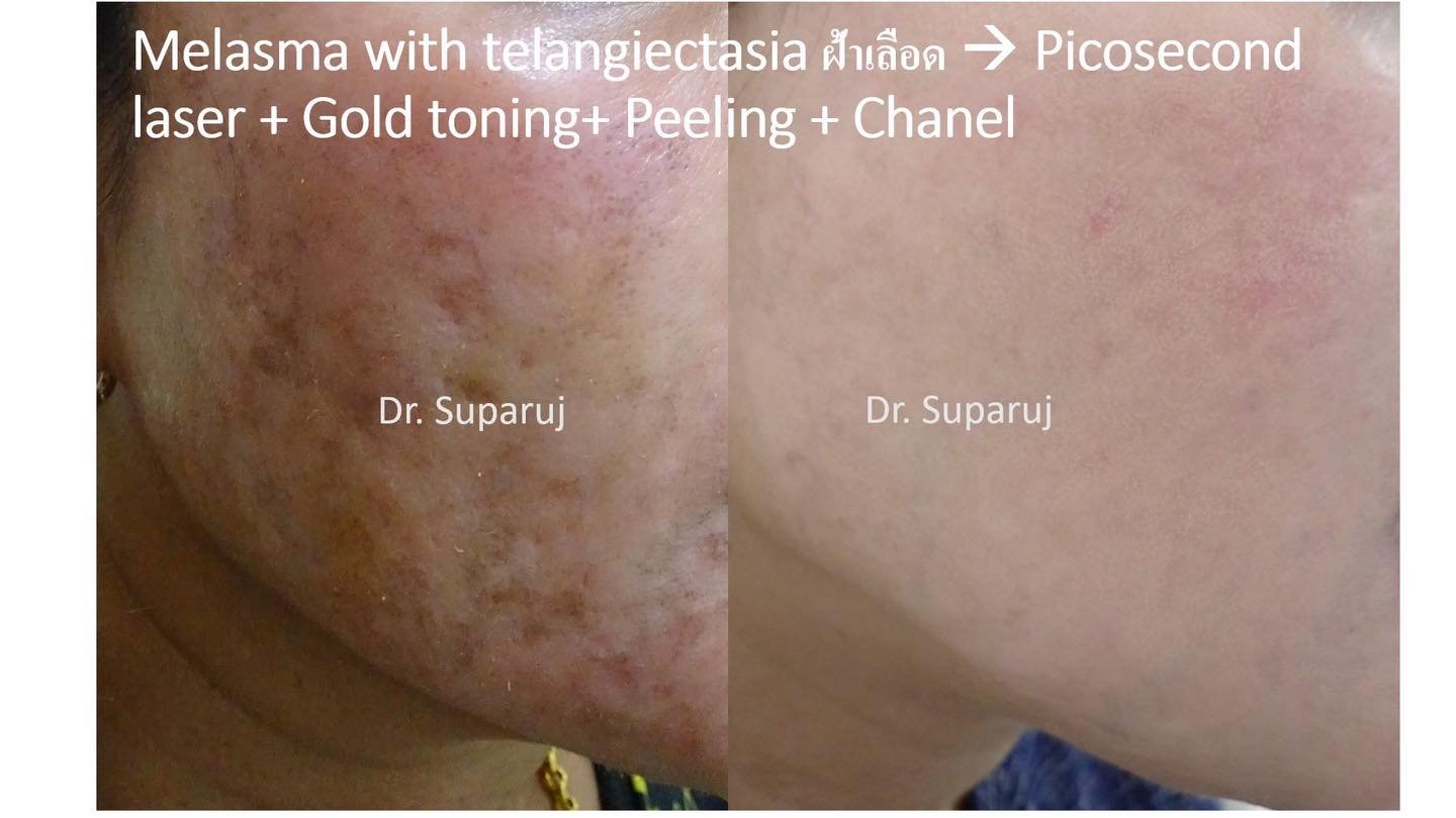 โปรแกรม ดูแลรักษาฝ้า Melasma Treatment Program โปรแกรม ดูแลรักษาฝ้า Melasma Treatment Program