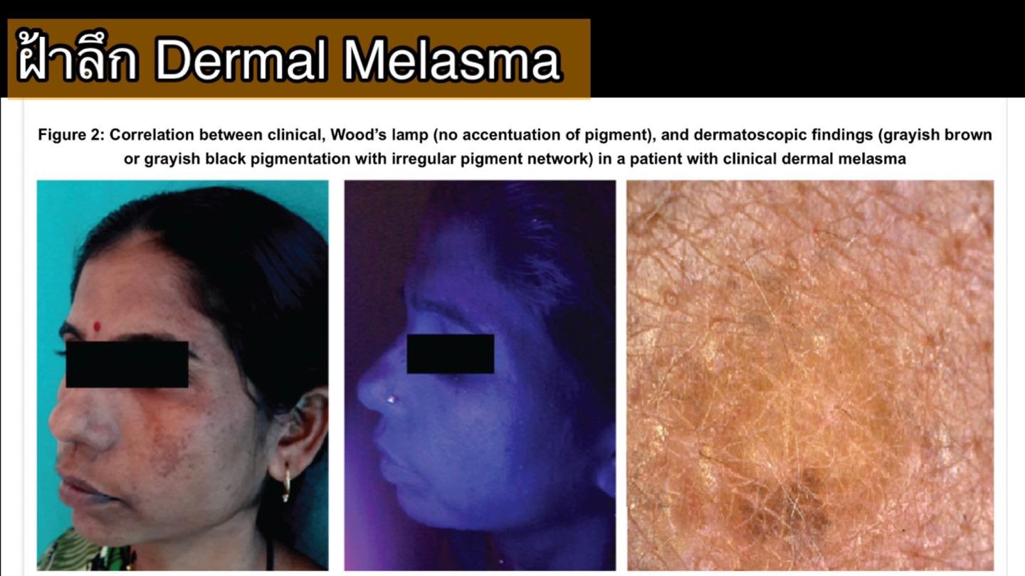 โปรแกรม ดูแลรักษาฝ้า Melasma Treatment Program โปรแกรม ดูแลรักษาฝ้า Melasma Treatment Program