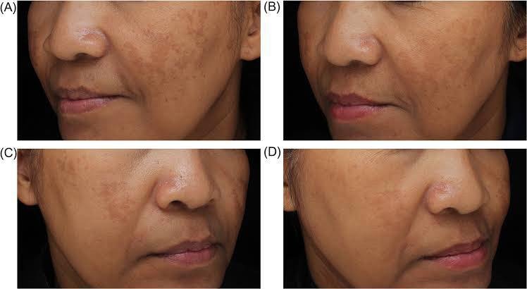โปรแกรม ดูแลรักษาฝ้า Melasma Treatment Program โปรแกรม ดูแลรักษาฝ้า Melasma Treatment Program