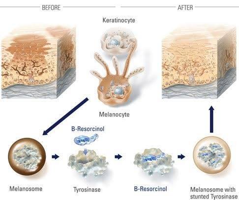 โปรแกรม ดูแลรักษาฝ้า Melasma Treatment Program โปรแกรม ดูแลรักษาฝ้า Melasma Treatment Program
