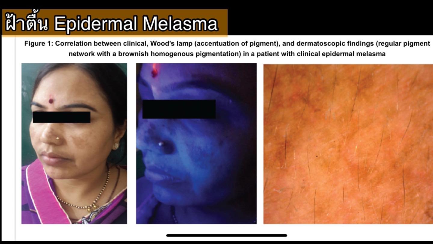 โปรแกรม ดูแลรักษาฝ้า Melasma Treatment Program โปรแกรม ดูแลรักษาฝ้า Melasma Treatment Program