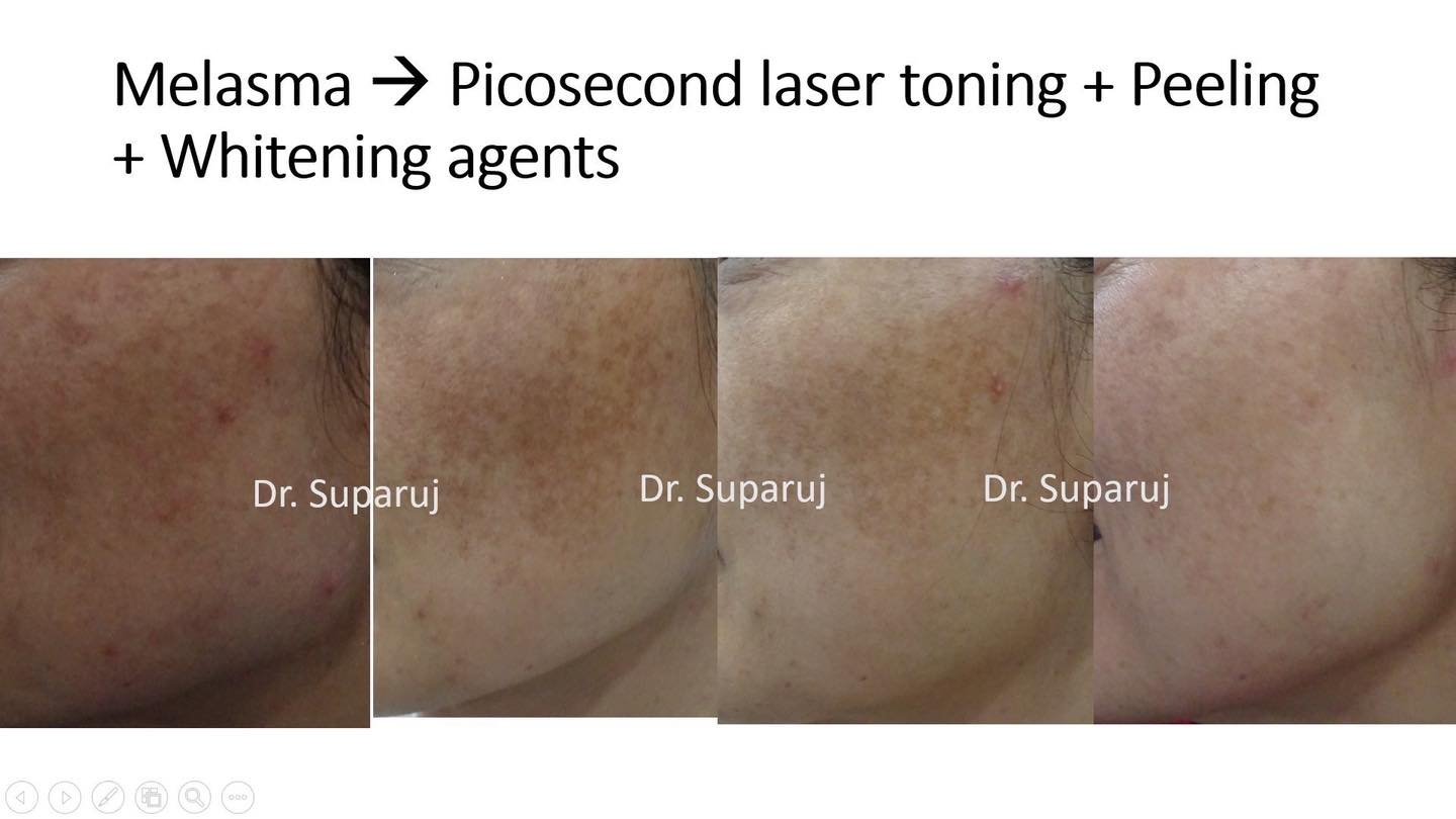 โปรแกรม ดูแลรักษาฝ้า Melasma Treatment Program