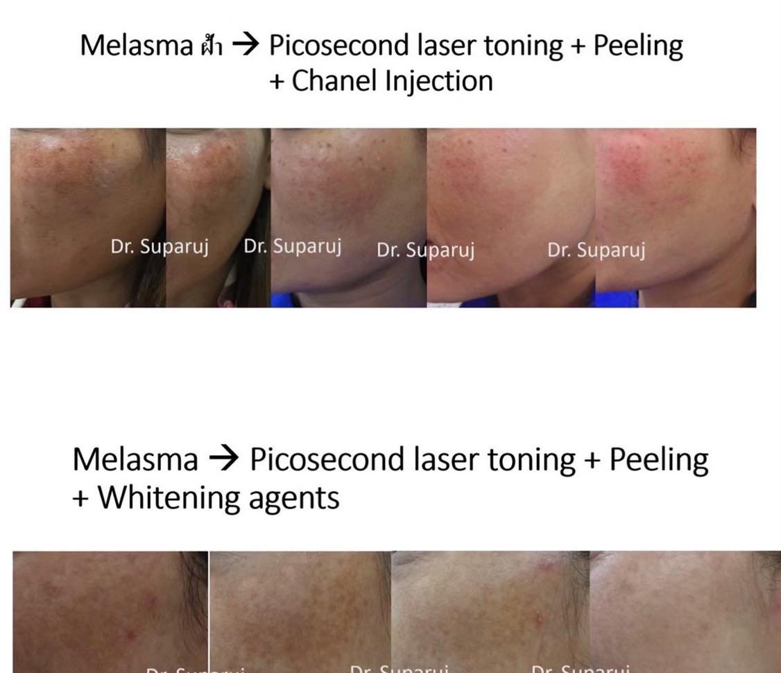 โปรแกรม ดูแลรักษาฝ้า Melasma Treatment Program โปรแกรม ดูแลรักษาฝ้า Melasma Treatment Program