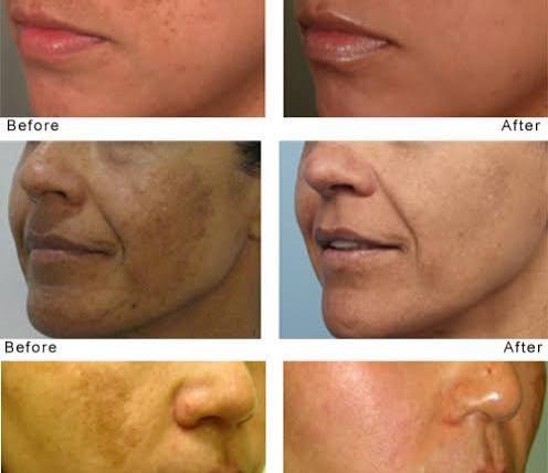 โปรแกรม ดูแลรักษาฝ้า Melasma Treatment Program