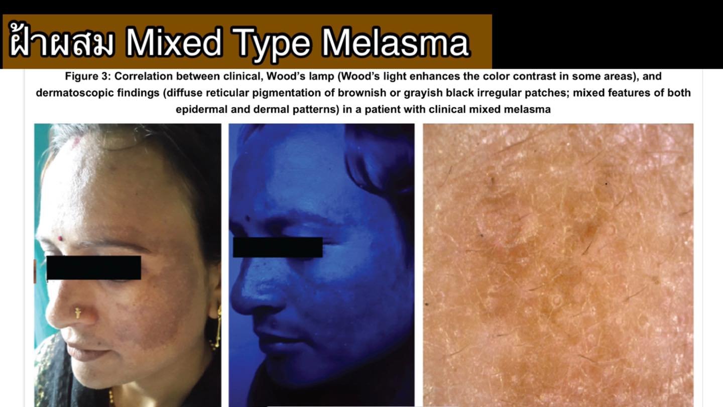 โปรแกรม ดูแลรักษาฝ้า Melasma Treatment Program