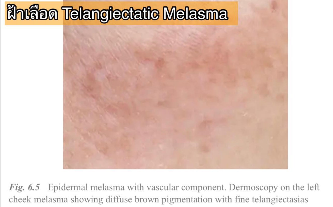 โปรแกรม ดูแลรักษาฝ้า Melasma Treatment Program โปรแกรม ดูแลรักษาฝ้า Melasma Treatment Program