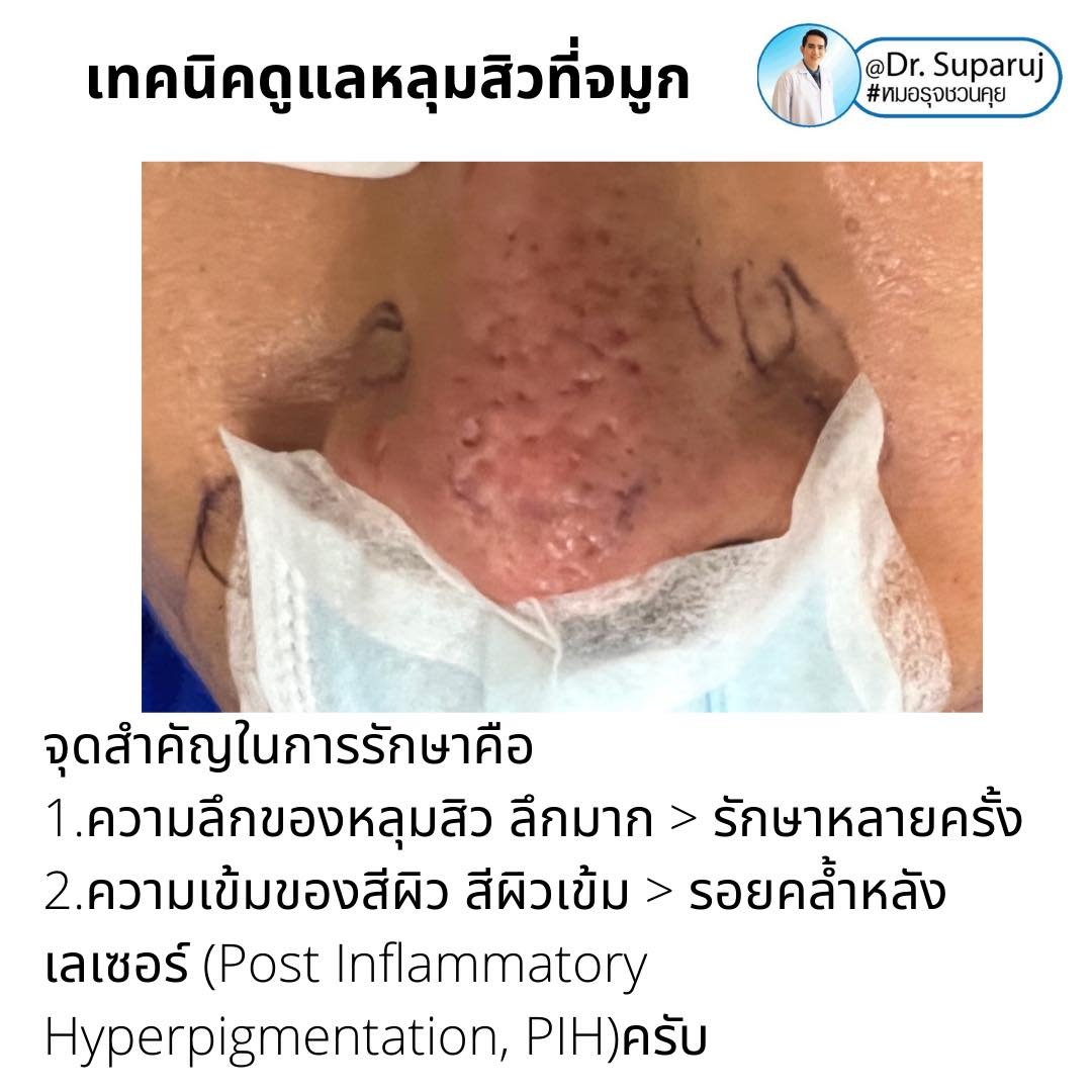 แผลเป็นจากสิวที่จมูก ดูแลได้อย่างไร Acne Scar on Nose ?