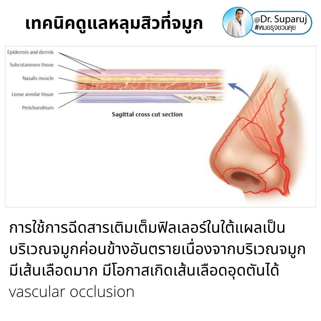 แผลเป็นจากสิวที่จมูก ดูแลได้อย่างไร Acne Scar on Nose ? แผลเป็นจากสิวที่จมูก ดูแลได้อย่างไร Acne Scar on Nose ?