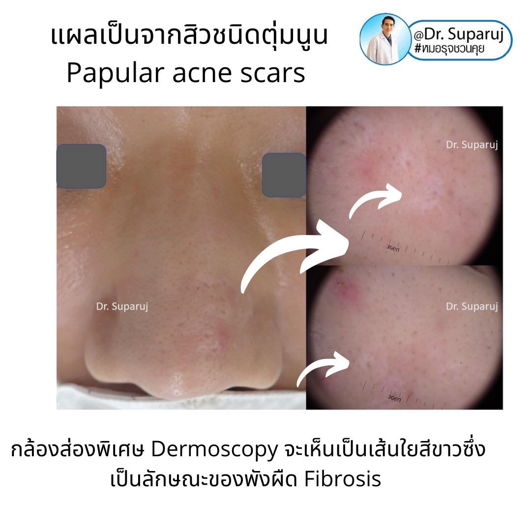 แผลเป็นจากสิวที่จมูก ดูแลได้อย่างไร Acne Scar on Nose ? แผลเป็นจากสิวที่จมูก ดูแลได้อย่างไร Acne Scar on Nose ?