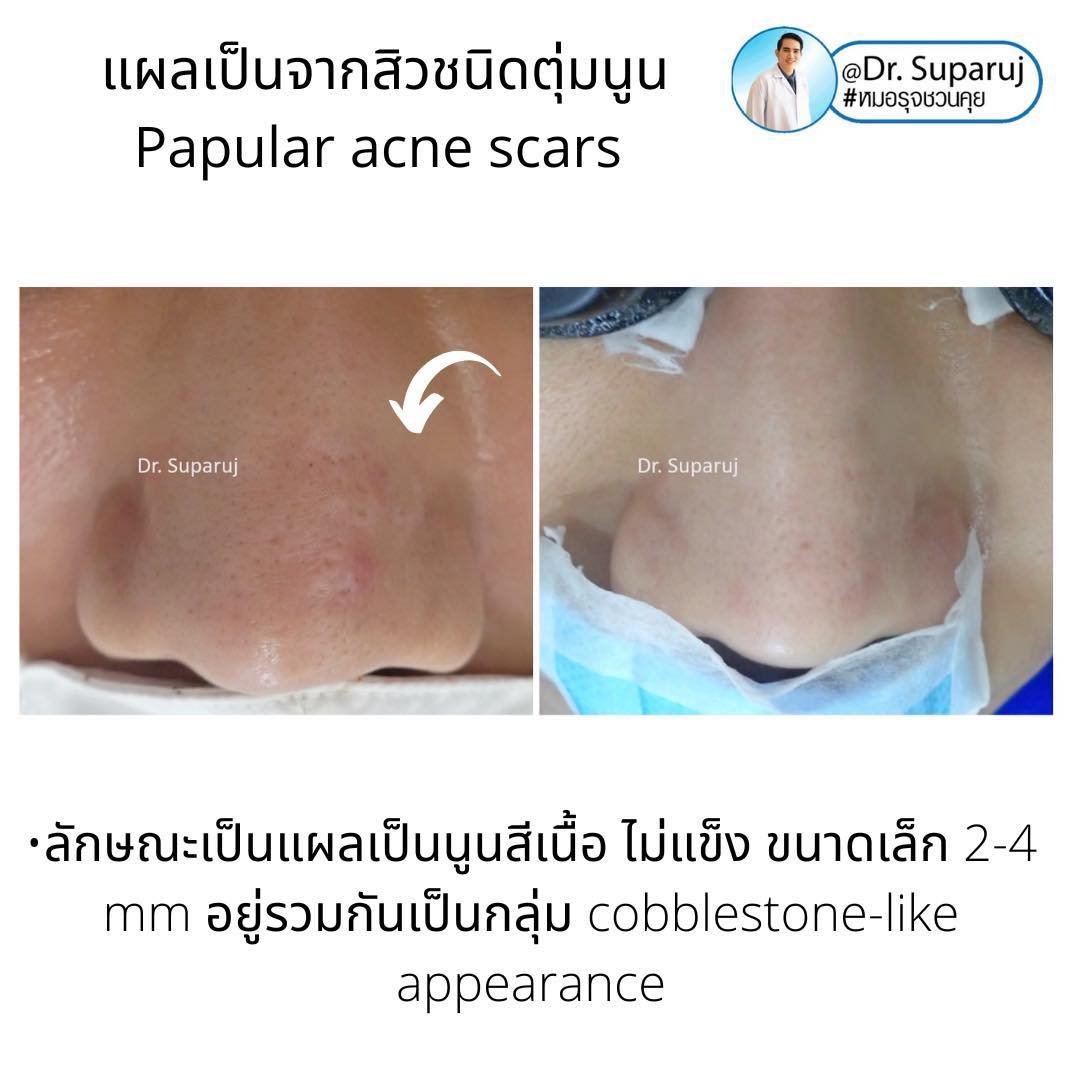 แผลเป็นจากสิวที่จมูก ดูแลได้อย่างไร Acne Scar on Nose ? แผลเป็นจากสิวที่จมูก ดูแลได้อย่างไร Acne Scar on Nose ?