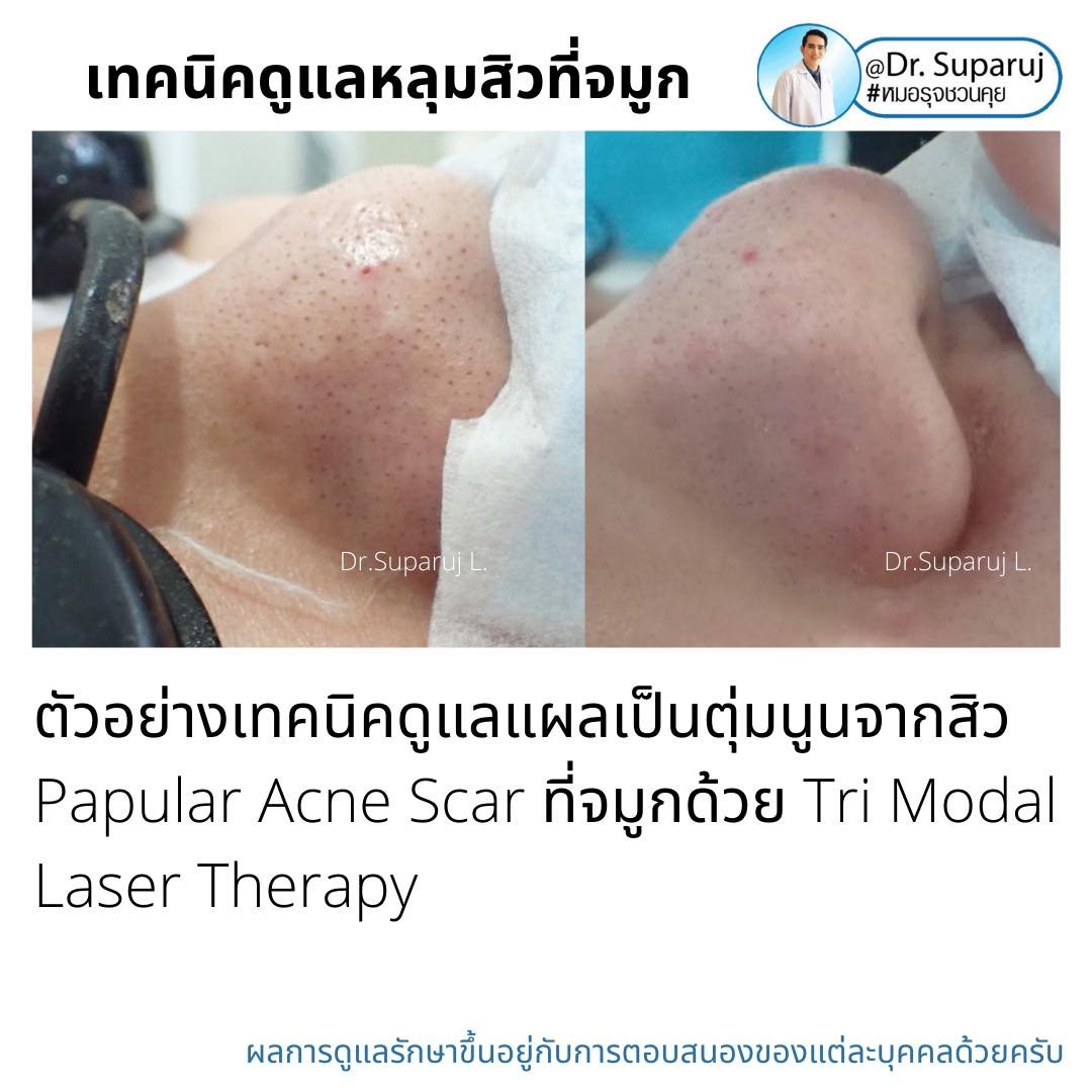 แผลเป็นจากสิวที่จมูก ดูแลได้อย่างไร Acne Scar on Nose ? แผลเป็นจากสิวที่จมูก ดูแลได้อย่างไร Acne Scar on Nose ?