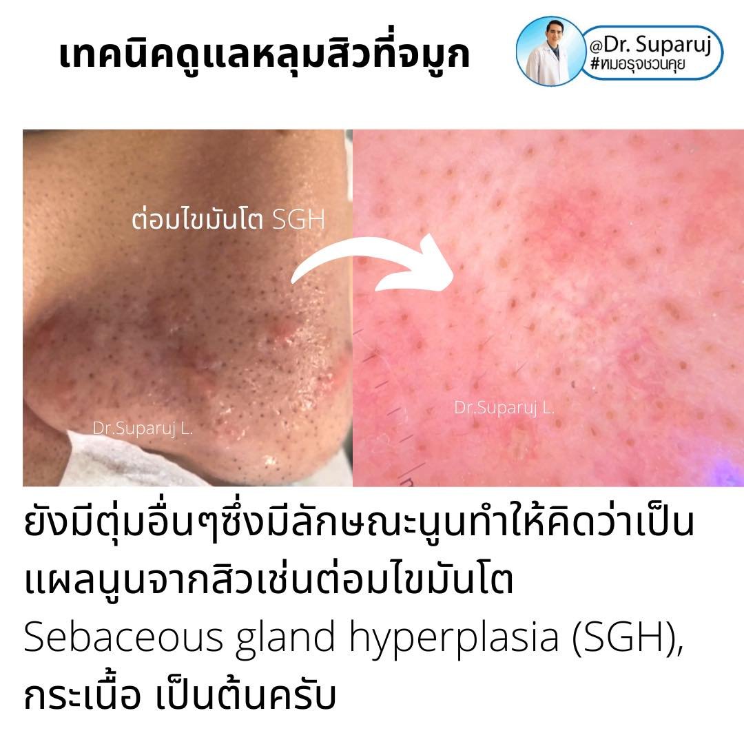 แผลเป็นจากสิวที่จมูก ดูแลได้อย่างไร Acne Scar on Nose ?