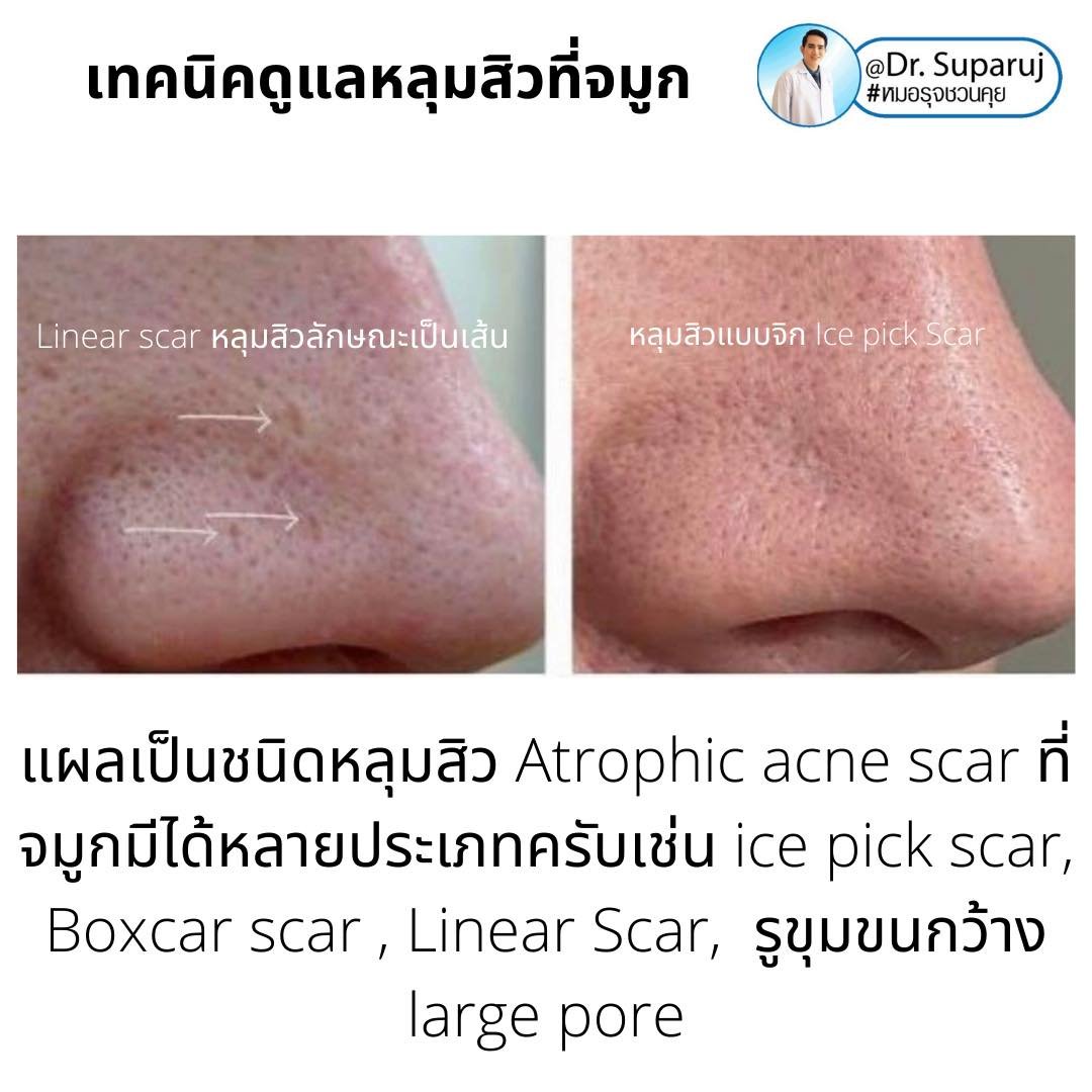 แผลเป็นจากสิวที่จมูก ดูแลได้อย่างไร Acne Scar on Nose ? แผลเป็นจากสิวที่จมูก ดูแลได้อย่างไร Acne Scar on Nose ?