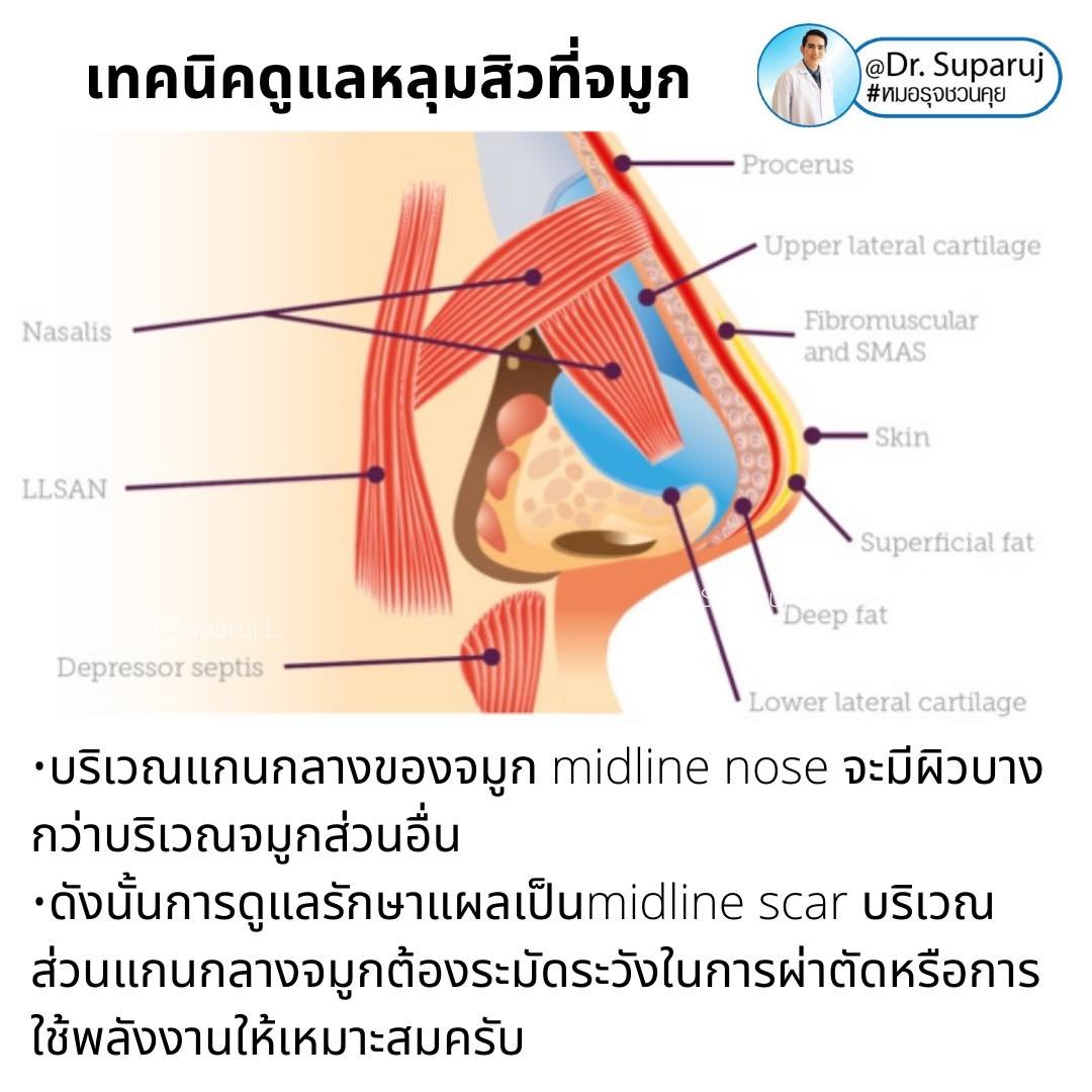 แผลเป็นจากสิวที่จมูก ดูแลได้อย่างไร Acne Scar on Nose ?