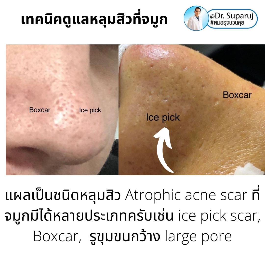 แผลเป็นจากสิวที่จมูก ดูแลได้อย่างไร Acne Scar on Nose ?