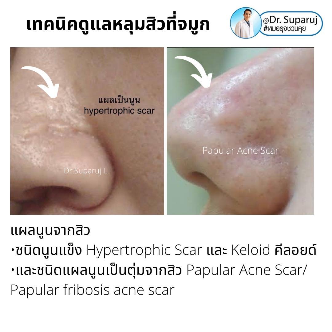 แผลเป็นจากสิวที่จมูก ดูแลได้อย่างไร Acne Scar on Nose ? แผลเป็นจากสิวที่จมูก ดูแลได้อย่างไร Acne Scar on Nose ?