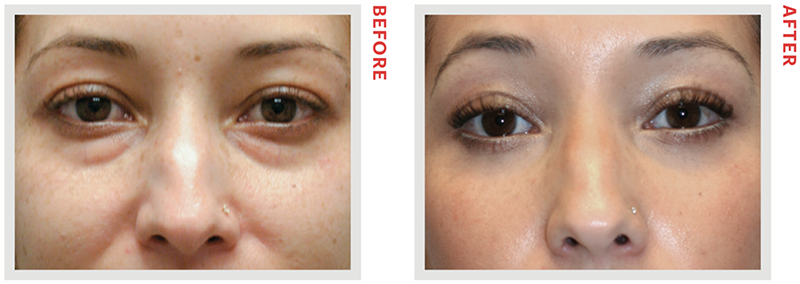 หนังตาตก คิ้วตก แก้ได้ไม่ต้องผ่าตัด ด้วยเลเซอร์แก้ไขหนังตาตก หนังตาตก คิ้วตก แก้ได้ไม่ต้องผ่าตัด ด้วยเลเซอร์แก้ไขหนังตาตก