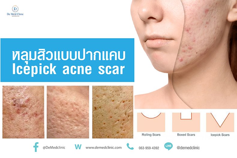 หลุมสิวแบบปากแคบ Icepick acne scar