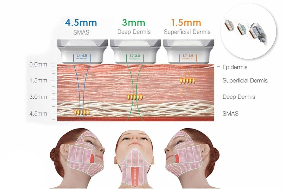 Ultraformer III HIFU MMFU นวัตกรรมใหม่ล่าสุดของการยกกระชับ Ultraformer III HIFU MMFU นวัตกรรมใหม่ล่าสุดของการยกกระชับ