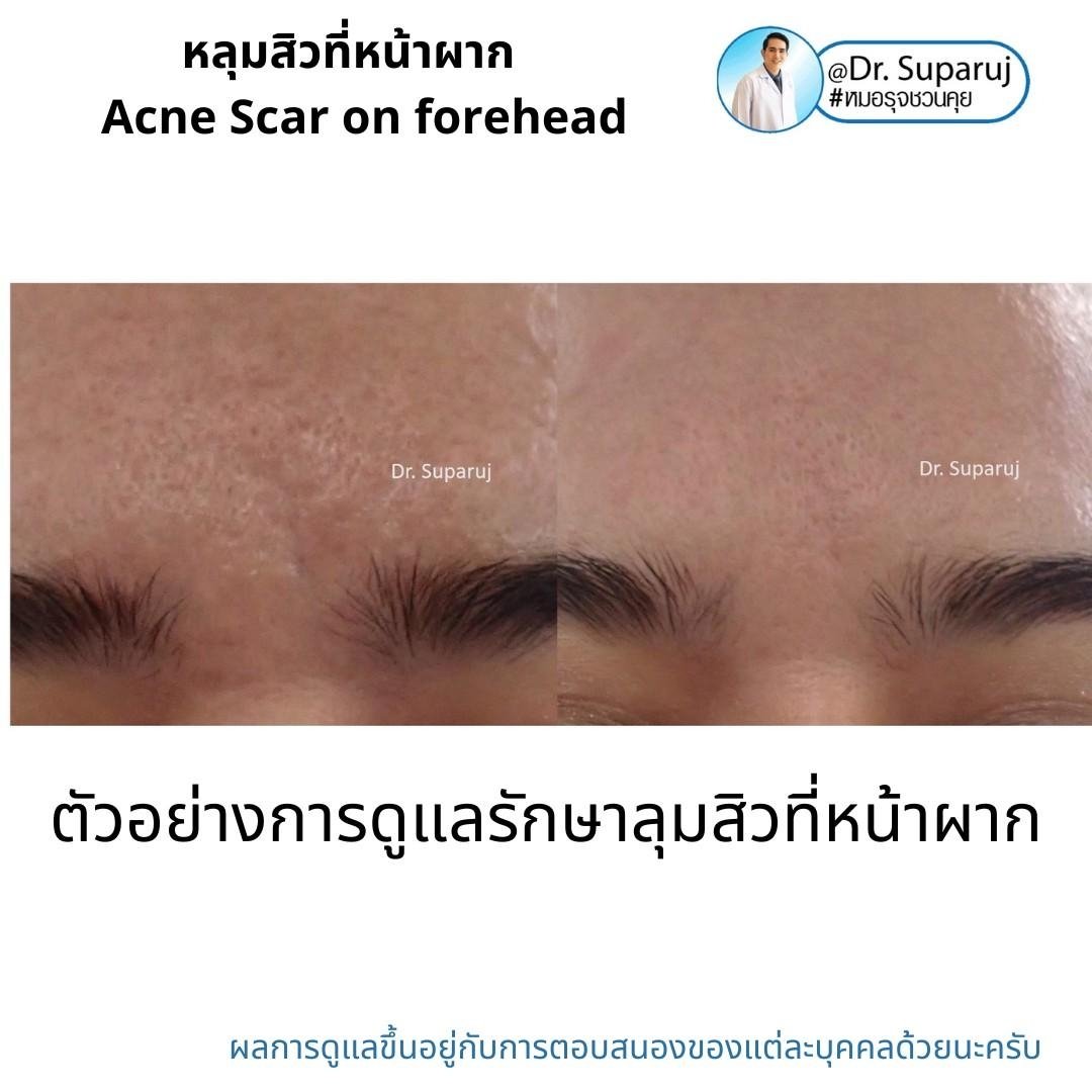 หลุมสิวที่หน้าผาก Acne Scar on forehead มีเทคนิคดูแลต่างจากบริเวณอื่นอย่างไร?