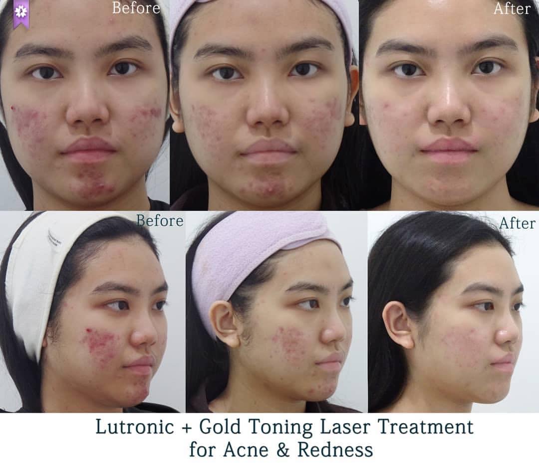 รอยแดงจากสิวเกิดจากอะไรและรักษาได้อย่างไร ? รอยแดงจากสิวเกิดจากอะไรและรักษาได้อย่างไร ?