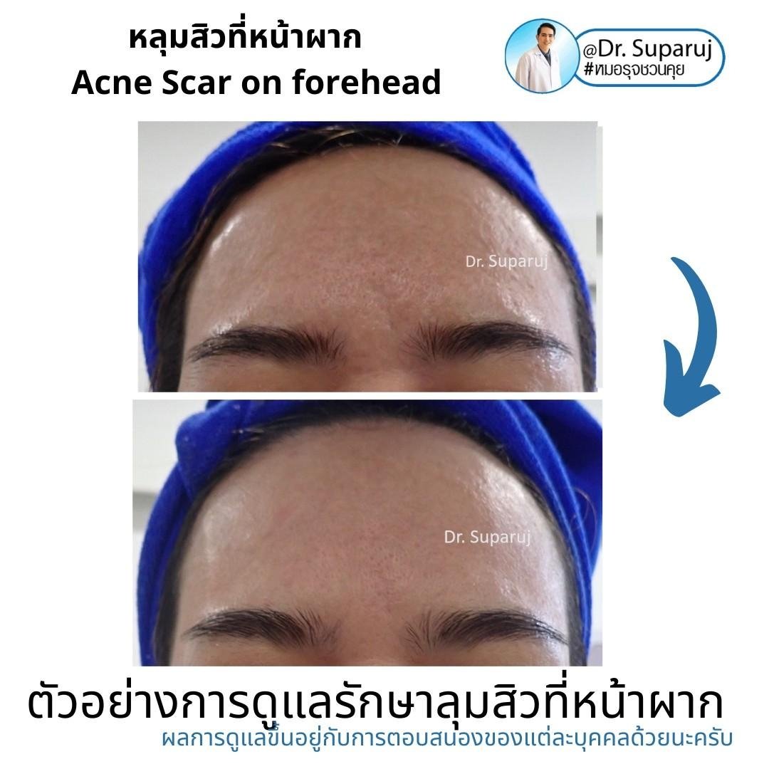 หลุมสิวที่หน้าผาก Acne Scar on forehead มีเทคนิคดูแลต่างจากบริเวณอื่นอย่างไร?