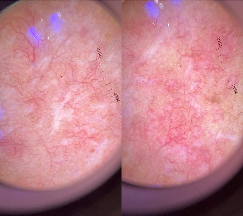 ฝ้าเลือด Telangiectatic Melasma ดูแลได้อย่างไร? ฝ้าเลือด Telangiectatic Melasma ดูแลได้อย่างไร?