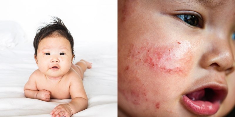 การเลือกผลิตภัณฑ์สำหรับทาป้องกันผื่นผ้าอ้อม การเลือกผลิตภัณฑ์สำหรับทาป้องกันผื่นผ้าอ้อม