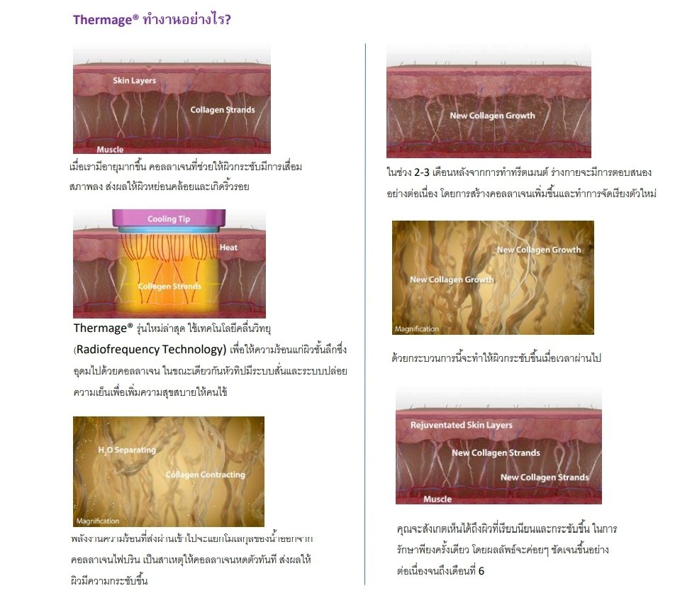 Thermage FLX Body Tip ดูแลปัญหาหน้าท้อง ต้นแขน ต้นขาไม่กระชับอย่างเห็นผล แบบ X 4 Thermage FLX Body Tip ดูแลปัญหาหน้าท้อง ต้นแขน ต้นขาไม่กระชับอย่างเห็นผล แบบ X 4