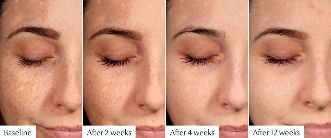 PicoLaser Melasma Treatment Program โปรแกรมดูแลฝ้าครบวงจร 